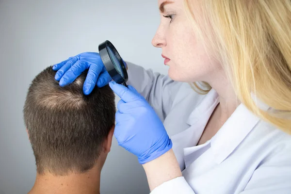 Alopecia Areata